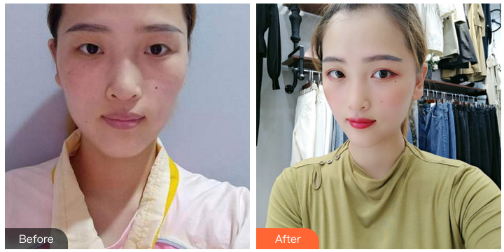 南京割双眼皮哪个医生比较好