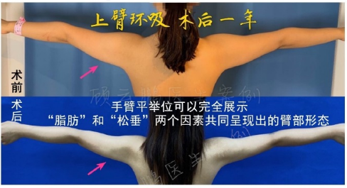 顾云鹏吸脂做得好吗，想做手臂吸脂多少钱？