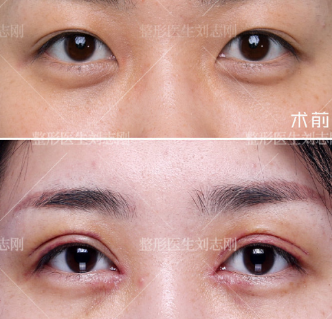 西安双眼皮修复最好的医生