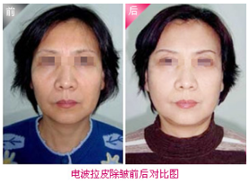上海九院谁做大拉皮最好