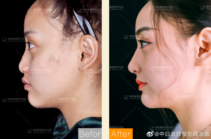 北京薛志强跟李劲良哪个做鼻综合效果好？