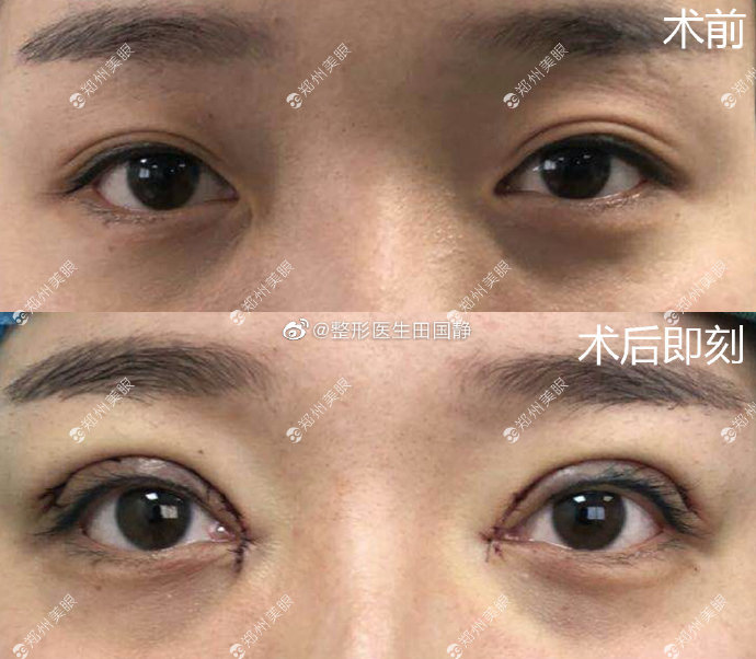 郑州有名眼修复专家是谁