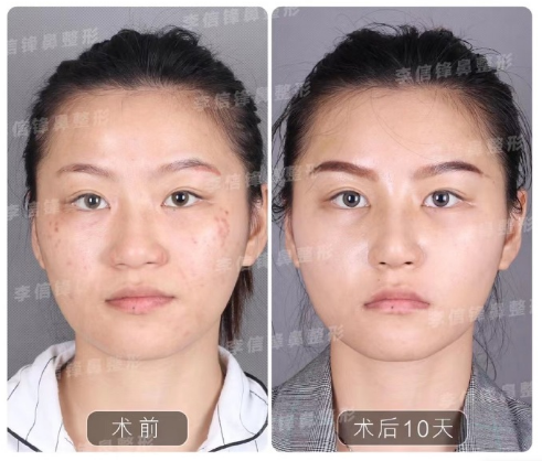 深圳李信锋隆鼻技术口碑怎样？李信锋隆鼻简介预约电话