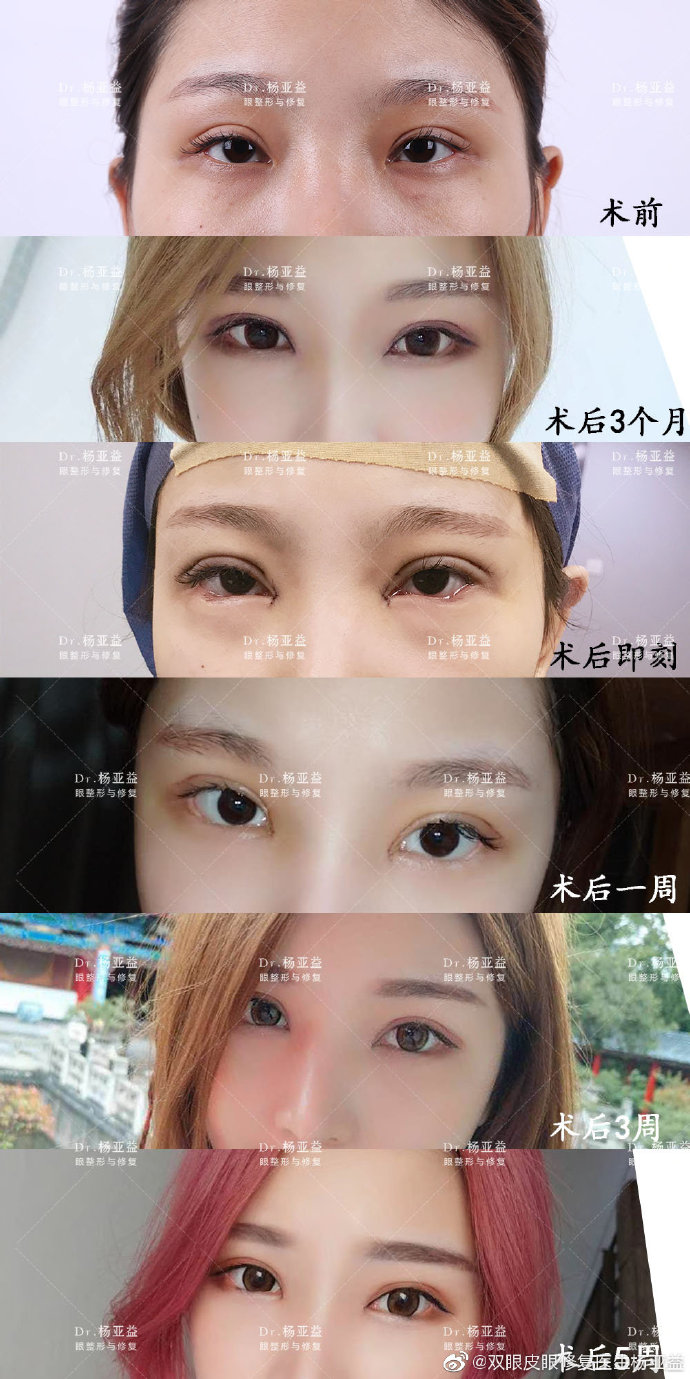 割双眼皮上海杨亚益跟朱迪谁更好