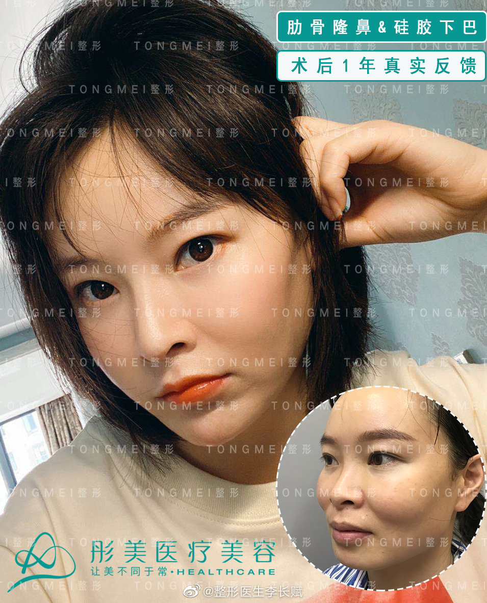 中国谁垫鼻子技术最好
