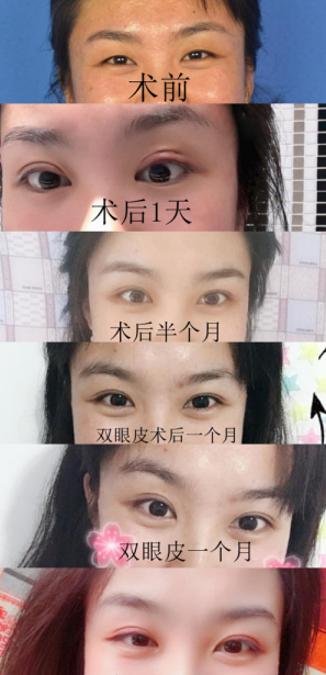 太原眼科医院任晓霞割双眼皮效果怎么样