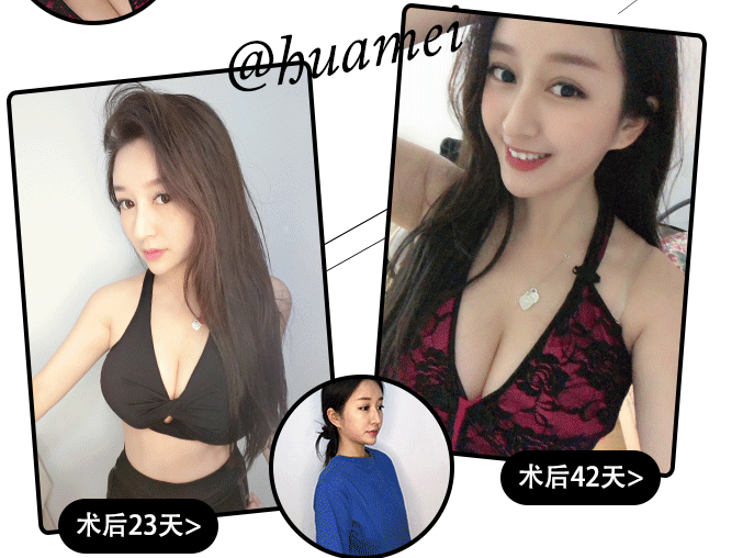 广州牟北平隆胸技术好吗？想做个假体材料的，求推荐。