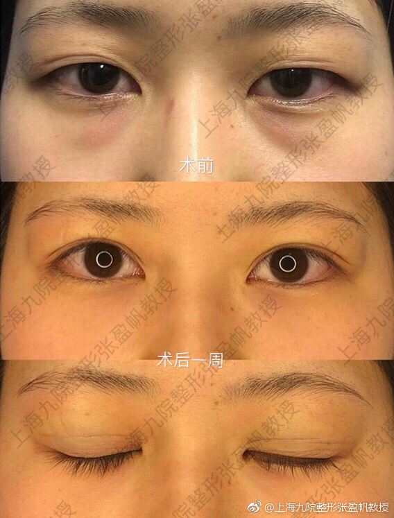 上海最好的修复双眼皮专家排行榜