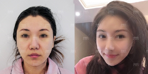 北京李晓东和杨大平哪个做面部提升比较好