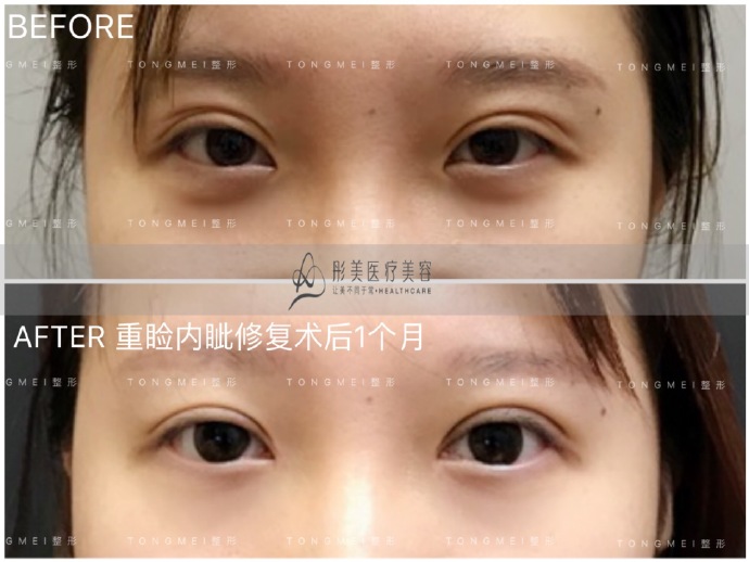 眼修复是找刘风卓还是王世勇？哪个技术靠谱？