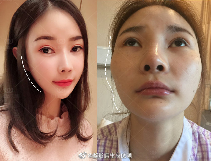 高俊明改脸型效果怎么样？技术好不好？