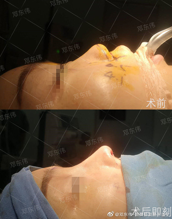 成都邓东伟和李萍哪个做鼻子最好