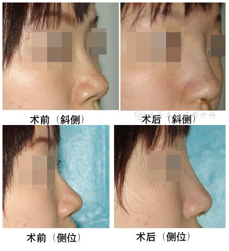 北医三院李东鼻修复技术好不好？大概价位多少？
