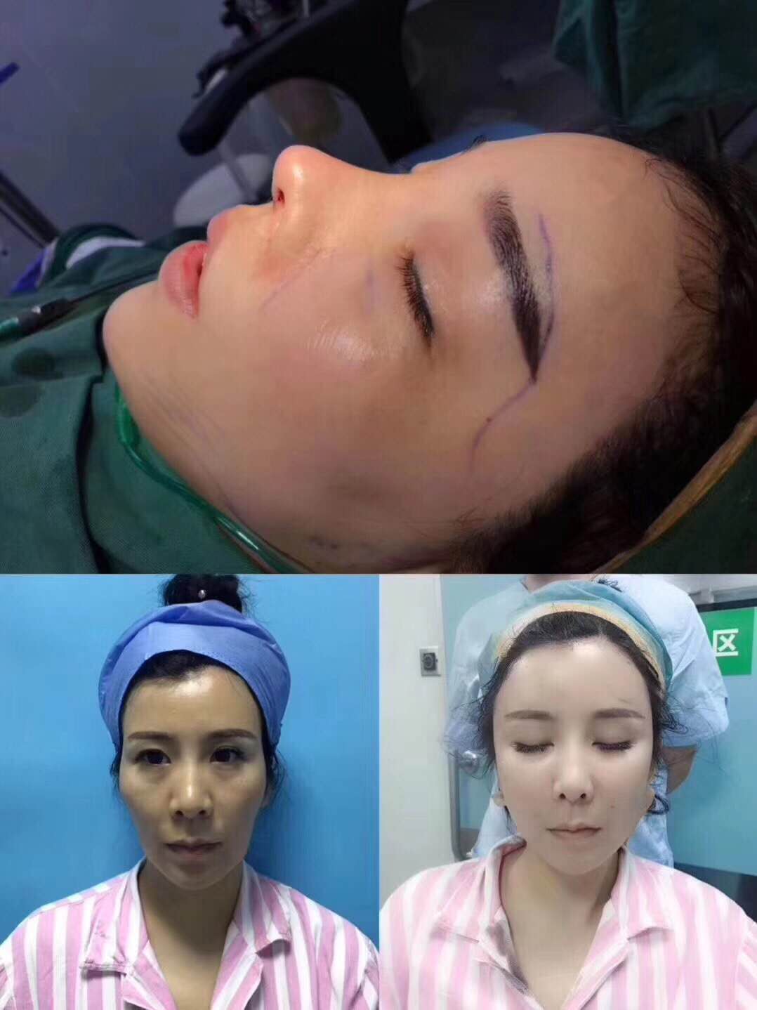 广州陈伯华整鼻案例和技术怎么样