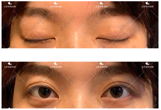 北京协和白明双眼皮做的怎么样？协和白明做眼修复和面部年轻化吗？