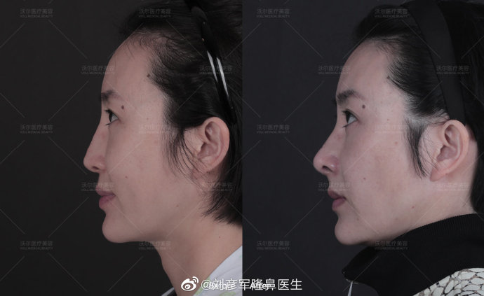 北京沃尔刘彦军隆鼻技术口碑好吗？