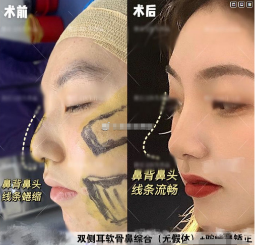 西安西京医院张曦做鼻子反馈口碑好吗？