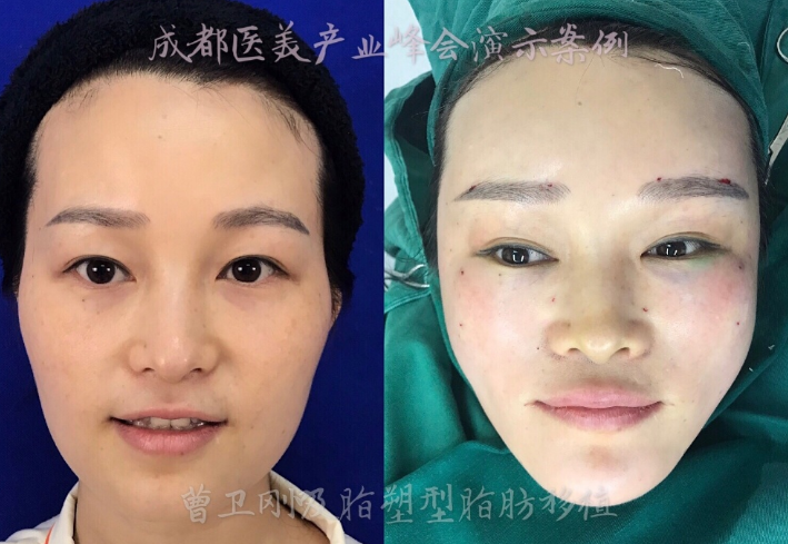 上海九院脂肪填充全脸哪个医生好？