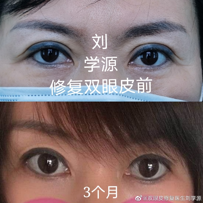 青岛刘学源双眼皮修复多少钱