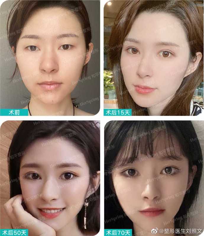 刘照文修复双眼皮怎么样
