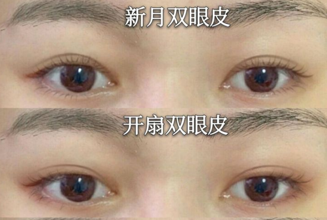 昆明做双眼皮最好的专家是谁