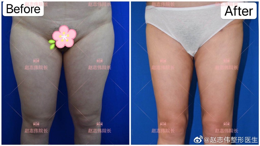 北京赵志伟吸脂技术怎么样？