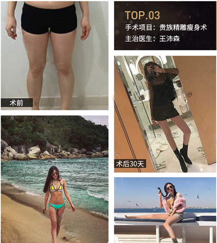 深圳吸脂好的医院和医生都有哪些？