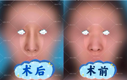 上海九院王守宝做肋骨鼻子怎么样？九院王守宝隆鼻怎么预约？