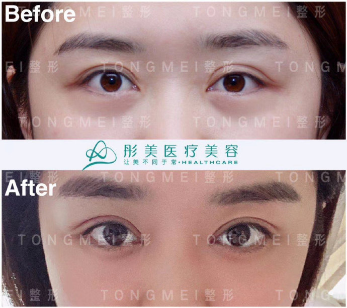 北京修复双眼皮专家是谁