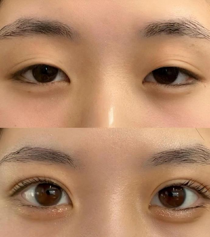 北京双眼皮医生哪个好？自然款妈生款的医生？