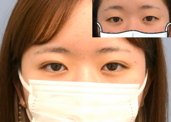 郑州做双眼皮哪个医生好？朱萌莹、李鹏杰、张芳、魏星？