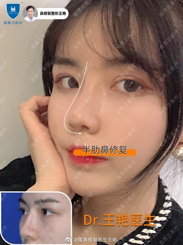 上海鼻子修复最好的医生是谁