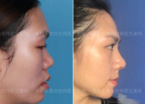 深圳鼻子修复最好的医生是谁