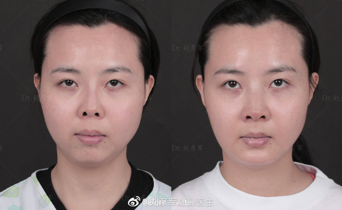 刘彦军和王英勇谁做鼻修复谁做得好？
