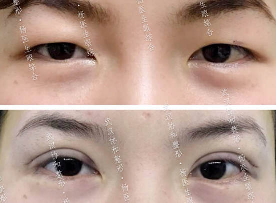 武汉协和杨杰割双眼皮怎么样