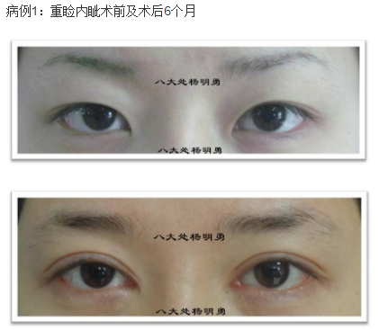 北京杨明勇做眼综合怎么样