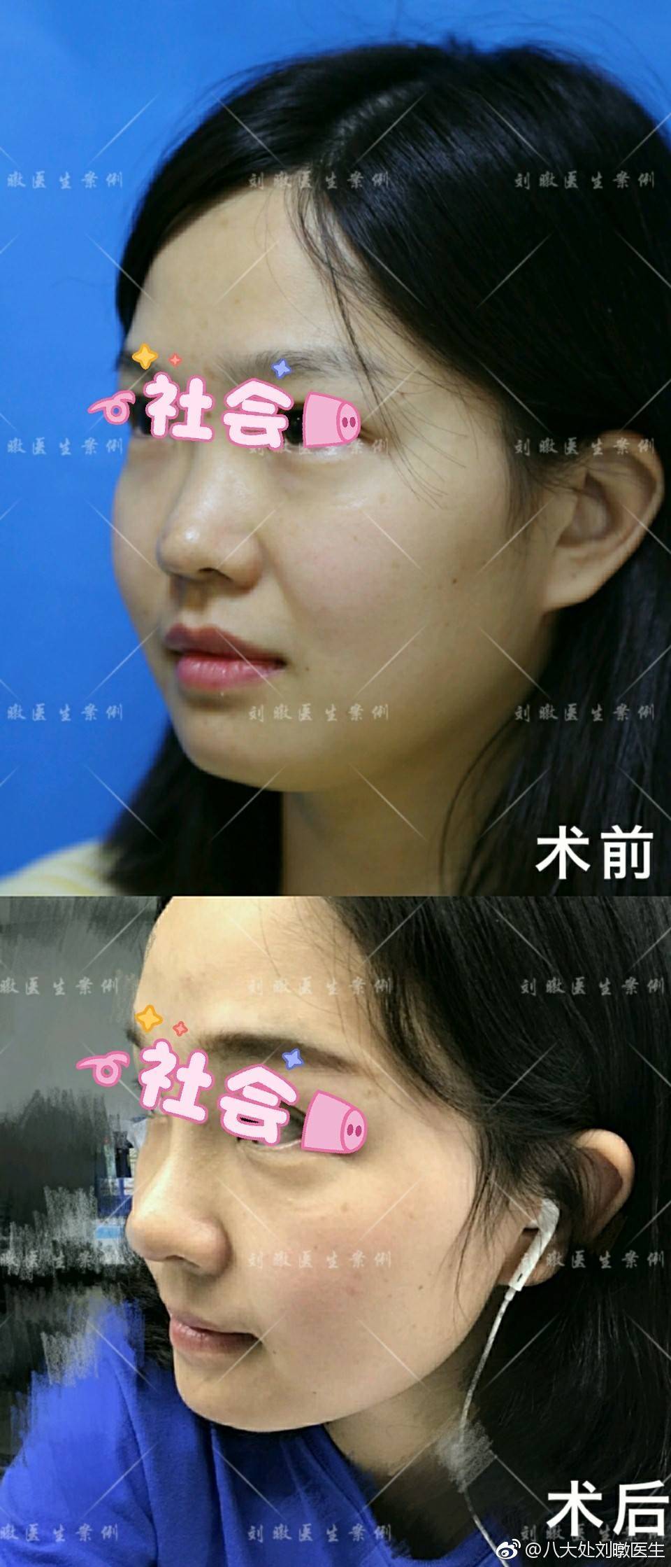 北京八大处刘暾王克明隆鼻谁最好？