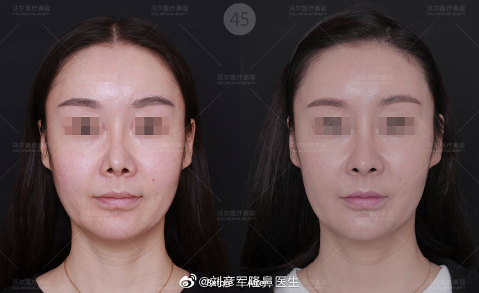 北京鼻修复专家权威有哪些？刘暾和刘彦军哪个好？