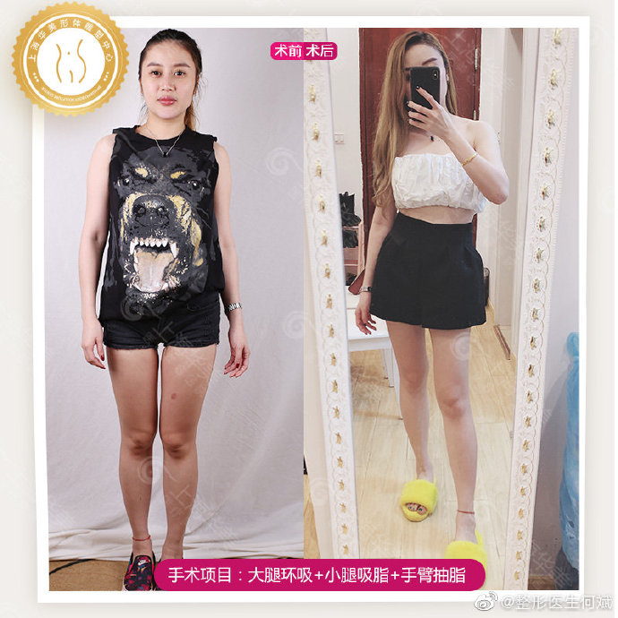 上海华美何斌吸脂塑身效果怎么样？