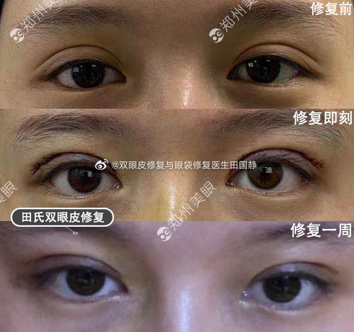 郑州杨丽和田国静哪个修复做的好