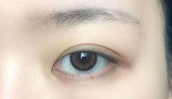 合肥双眼皮修复方面的专家医生