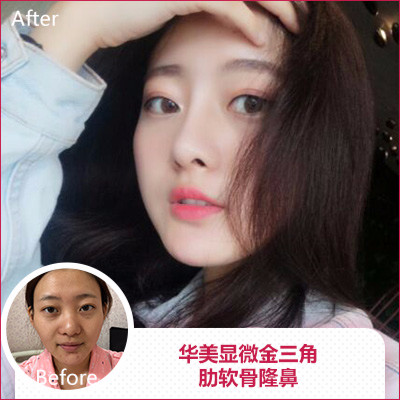 南京做鼻子最好的医生是谁？