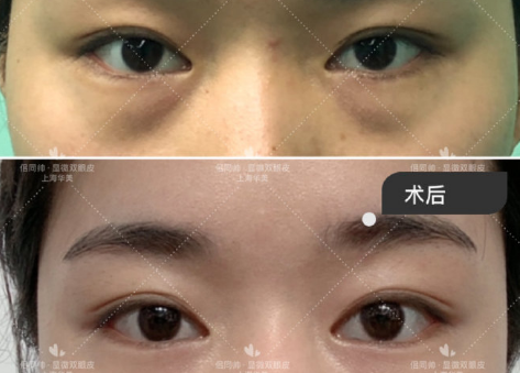 上海双眼皮修复医生哪个最好