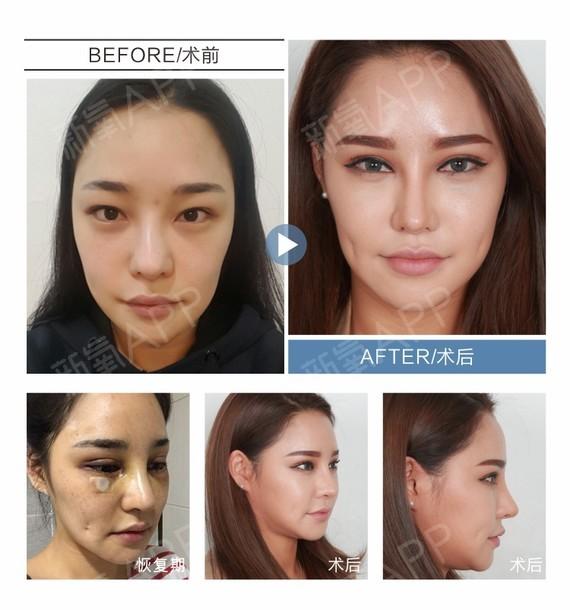 孙熙东修复双眼皮怎么样