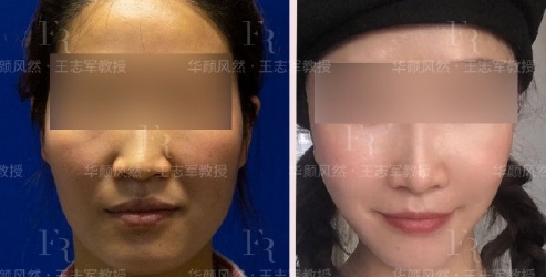 北京面部提升王志军和杨大平哪个厉害