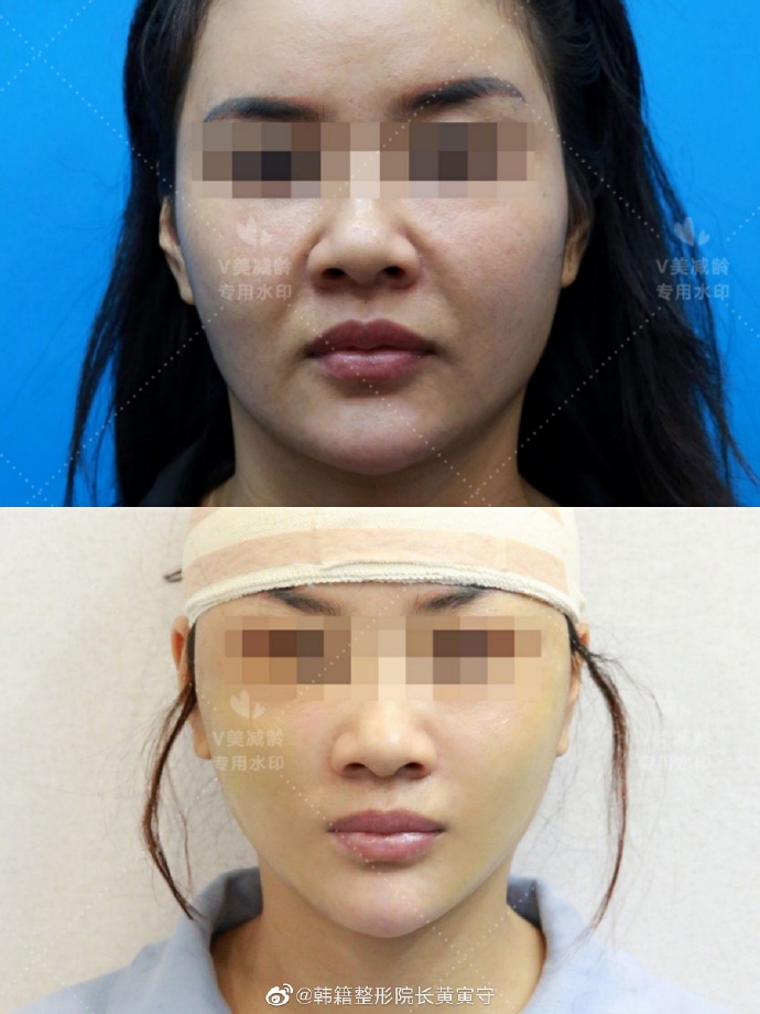 黄寅守和杜太超谁做提升效果好