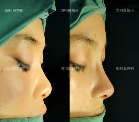 成都铜雀台周柯做鼻子怎么样