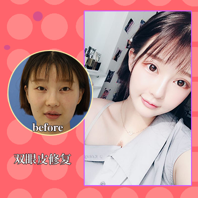 闫迎军双眼皮修复案例和双眼皮修复费用、评价