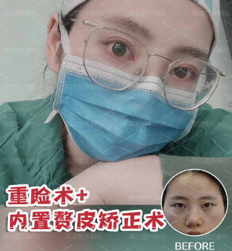 解灿和张娇娇哪个做双眼皮做得更好