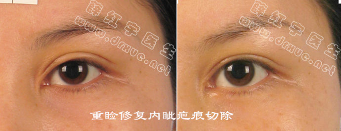 薛红宇双眼皮修复真实案例:内眦疤痕切除